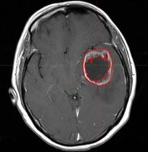 Brain MRI with segmentation