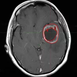Brain MRI with segmentation
